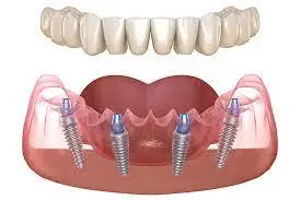 All-on-4 implant